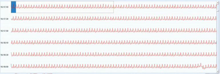 Muestra de una página del examen Holter donde se observa la taquicardia ventricular monomórfica sostenida.