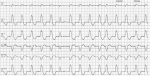 Trazado electrocardiográfico 5 mm/mV y 50 mm/s. Presencia de taquicardia ventricular monomórfica interrumpida por un complejo sinusal.