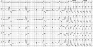 Trazado electrocardiográfico. ECG de 6 derivaciones con un ritmo bigémino ventricular y el inicio de una salva de taquicardia ventricular.
