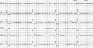 razado electrocardiográfico 5 mm/mV y 50 mm/s. Ritmo bigémino ventricular.﻿