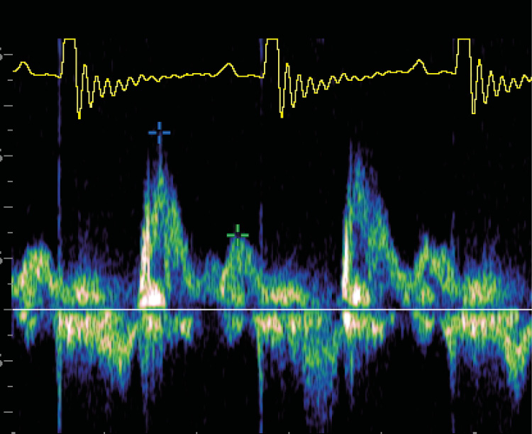 Ecocardiografía con hipertrofia concéntrica difusa de septo interventricular y pared libre ventricular izquierda, grave dilatación de atrio izquierdo, flujo transmitral restrictivo compatible con disfunción diastólica grado III e insuficiencia mitral de alta velocidad que sugiere hipertensión arterial sistémica.