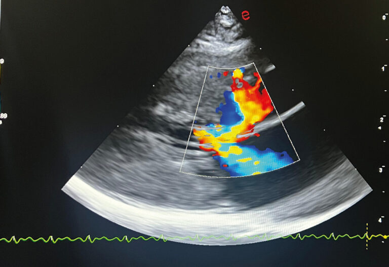 Ecocardiografía vista paraesternal derecha eje largo, con Doppler color, presencia de SAM