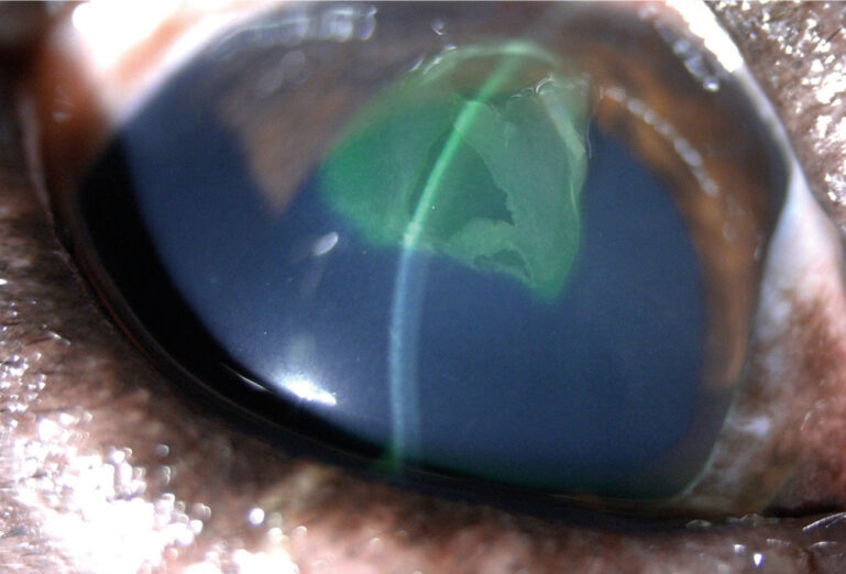 Úlcera de bordes desprendidos: la fluoresceína difunde bajo el epitelio que no logra anclarse al estroma.