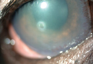 Úlceras complicadas. Estromal anterior asociada a infiltrado celular