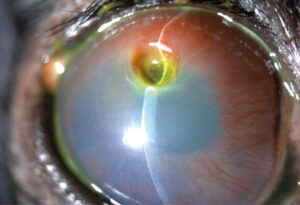 Úlceras complicadas. Estromal profunda predescemética asociada a neovascularización crónica.﻿