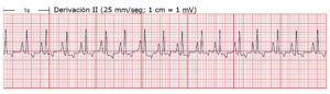 Electrocardiograma mostrando la derivación II con cuadrícula