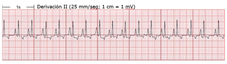 Electrocardiograma mostrando la derivación II con cuadrícula