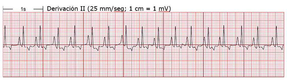 Electrocardiograma mostrando la derivación II con cuadrícula