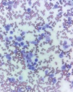 Imagen citológica de histiocitoma cutáneo.