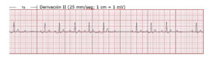 Electrocardiograma de derivación II con cuadrícula y mediciones