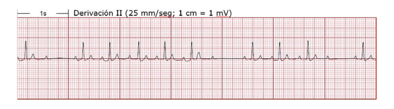 Electrocardiograma de derivación II con cuadrícula y mediciones