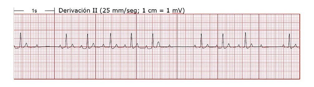 Electrocardiograma de derivación II con cuadrícula y mediciones