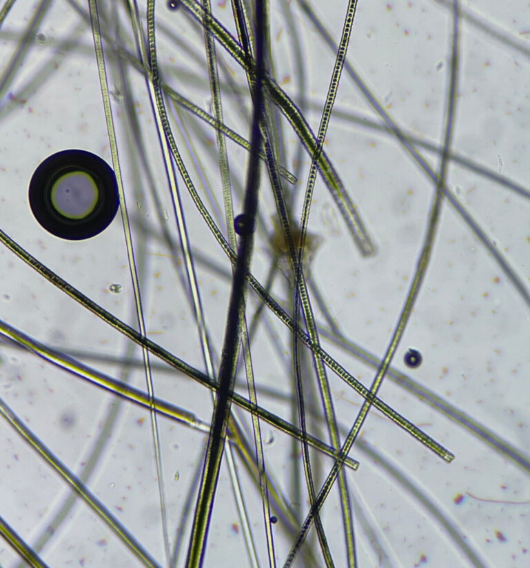 Imagen 5. Examen microscópico del pelo de las regiones afectadas. Se observan puntas rotas en la mayoría de los pelos estudiados. Las raíces están intactas y hay una ligera queratosis peripilar. No se observan formas parasitarias ni cambios compatibles con dermatofitosis.