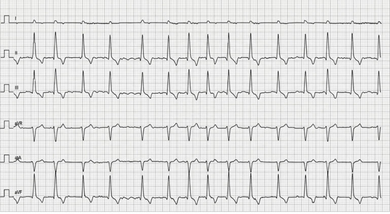 Electrocardiograma de un perro donde se observa fibrilación atrial.
