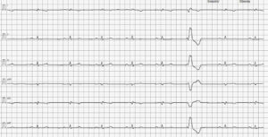 Trazado electrocardiográfico 5 mm/mV y 50 mm/s. Se observa conversión a ritmo sinusal con un único CPV aislado.﻿