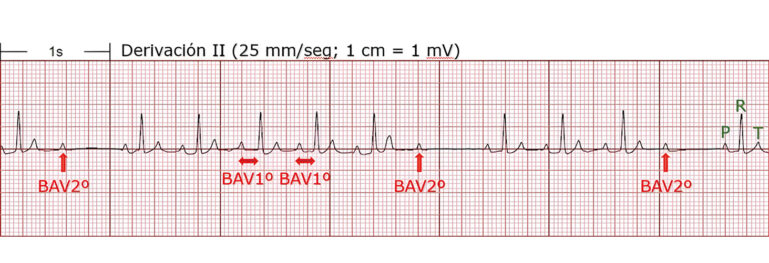 Electrocardiograma mostrando BAV en derivación II con anotaciones