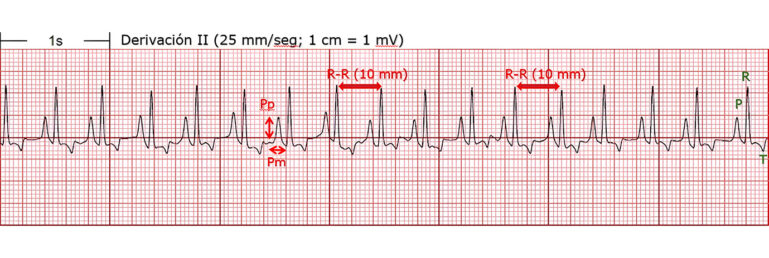 Electrocardiograma de derivación II mostrando ondas P, R y T.