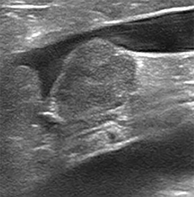Imágenes ecográficas de la glándula adrenal derecha aumentada de tamaño compatibles con neoplasia adrenal y trombo en dicha vena.