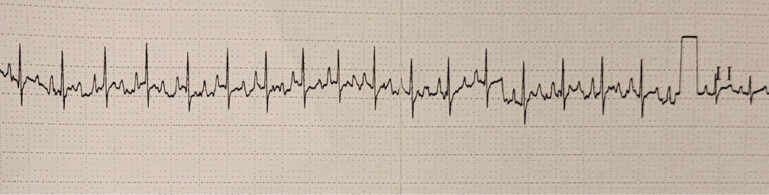Electrocardiograma de superficie a velocidad 25 mm/segundo con taquicardia sinusal a 200 latidos por minuto.