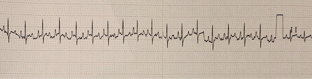 Electrocardiograma de superficie a velocidad 25 mm/segundo con taquicardia sinusal a 200 latidos por minuto.