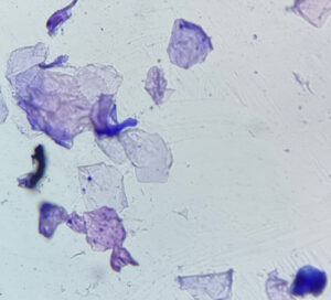 Imagen 6A.﻿ Citología con cinta adhesiva de todas las superficies afectadas. Se aprecia una gran cantidad de corneocitos