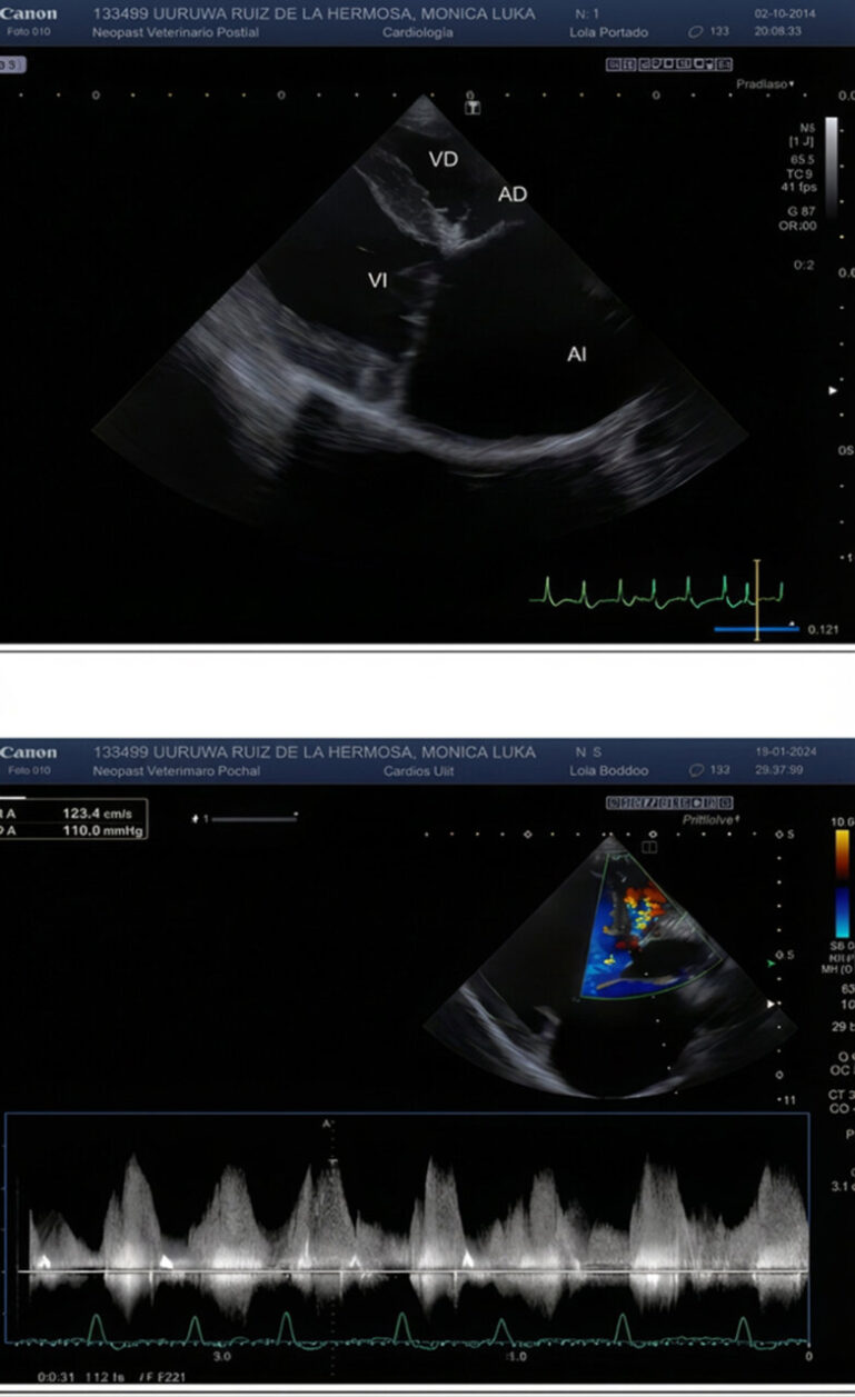 Ecocardiografía en la que se aprecian el defecto del septo interventricular y la dilatación de la aurícula y el ventrículo izquierdos.