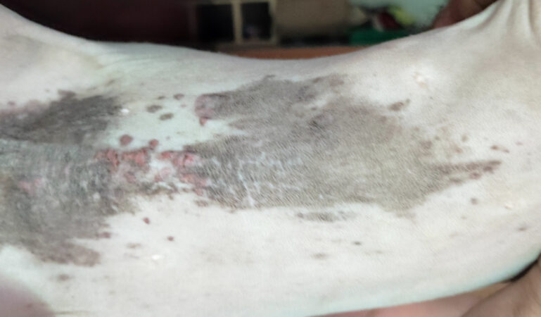 Imagen de un mastocitoma. Aspecto de las lesiones tras dos semanas de tratamiento.