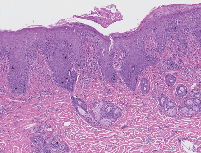 Imagen histopatológica de mastocitoma en tejido