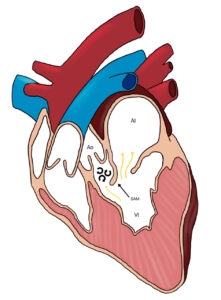 Diagrama de la obstrucción del tracto de salida del ventrículo izquierdo resultante del movimiento sistólico anterior (SAM) de la valva anterior de la válvula mitral