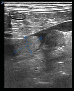 Imágenes ecográficas de la glándula adrenal derecha aumentada de tamaño compatibles con neoplasia adrenal y trombo en dicha vena.
