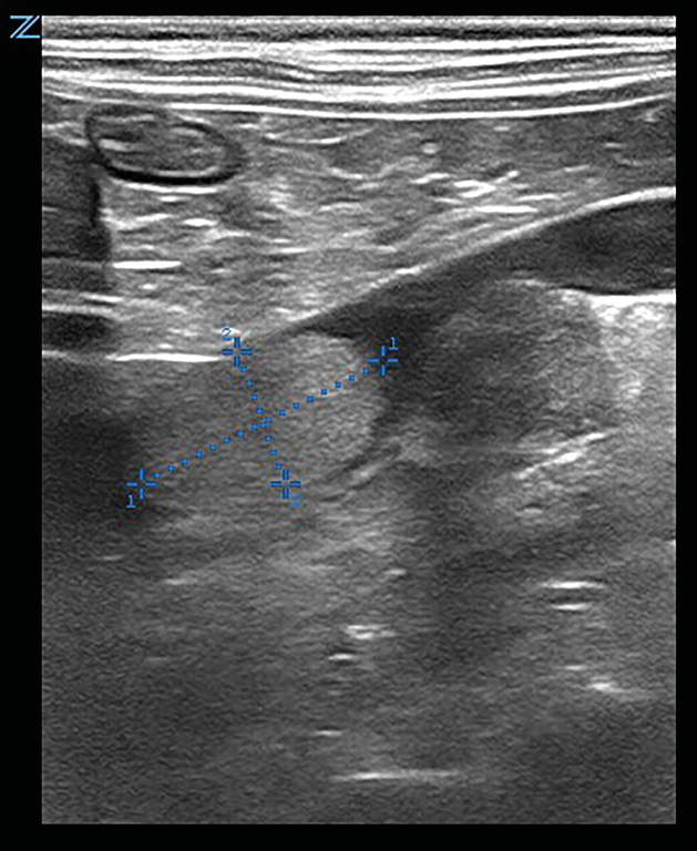 Imágenes ecográficas de la glándula adrenal derecha aumentada de tamaño compatibles con neoplasia adrenal y trombo en dicha vena.
