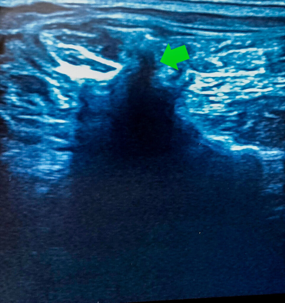 Imagen ecográfica del abordaje transversal (TVS) del BESP a nivel lumbar.