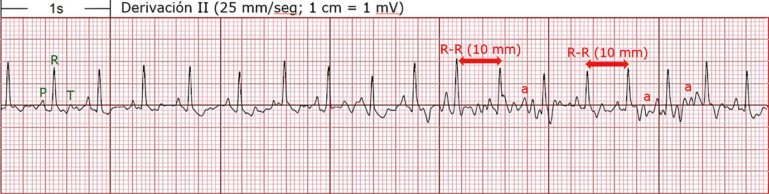 Electrocardiograma de derivación II mostrando ondas R, P y T.
