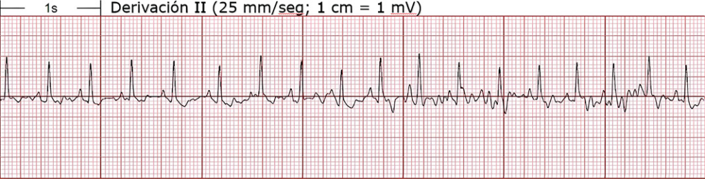 Electrocardiograma de derivación II mostrando actividad eléctrica del corazón.