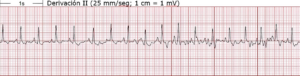 Electrocardiograma de derivación II mostrando actividad eléctrica del corazón.