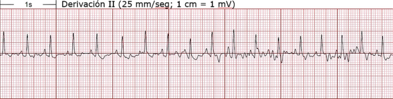 Electrocardiograma de derivación II mostrando actividad eléctrica del corazón.