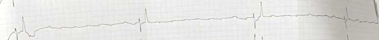 Electrocardiograma mostrando bloqueo AV de tercer grado. Derivación II 10 mm/mV y 25 mm/s.