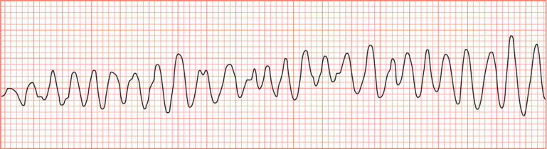 ECG derivación II 50mm/s. Patrón de fibrilación ventricular. en perro.