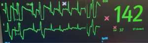 ECG derivación II. Perro tras dilatación y vólvulo gástrico con presencia de complejos ventriculares prematuros sin compromiso hemodinámico.