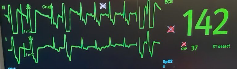 ECG derivación II. Perro tras dilatación y vólvulo gástrico con presencia de complejos ventriculares prematuros sin compromiso hemodinámico.