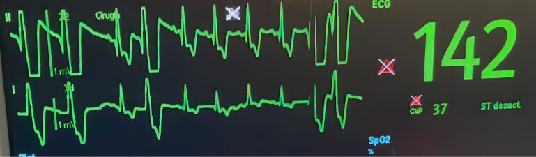 ECG derivación II. Perro tras dilatación y vólvulo gástrico con presencia de complejos ventriculares prematuros sin compromiso hemodinámico.
