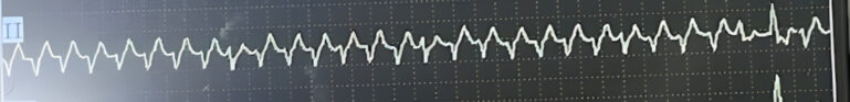ECG derivación II 10 mm/mV en perro con taquicardia ventricular.