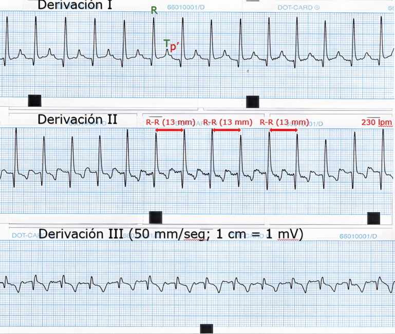 Electrocardiograma mostrando las derivaciones I, II y III con mediciones.