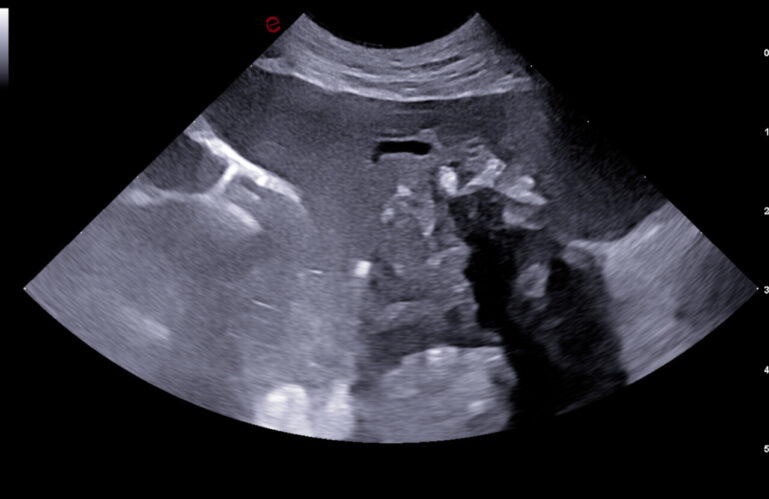 Ecografía pulmonar donde se aprecia pulmón hepatizado con focos irregulares y de diversa ecogenicidad compatible con un absceso.