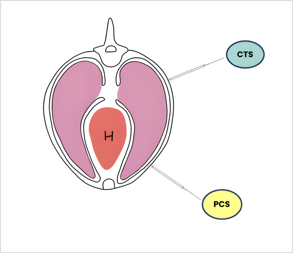 Esquema de los puntos T-FAST CTS y PCS en vista transversal del tórax y colocación de la sonda ecográfica en un ángulo de 90º con la superficie pulmonar.
