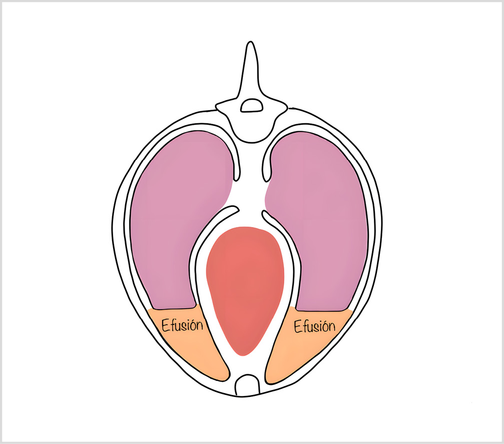 DEsquema de un paciente con efusión pleural en decúbito esternal.