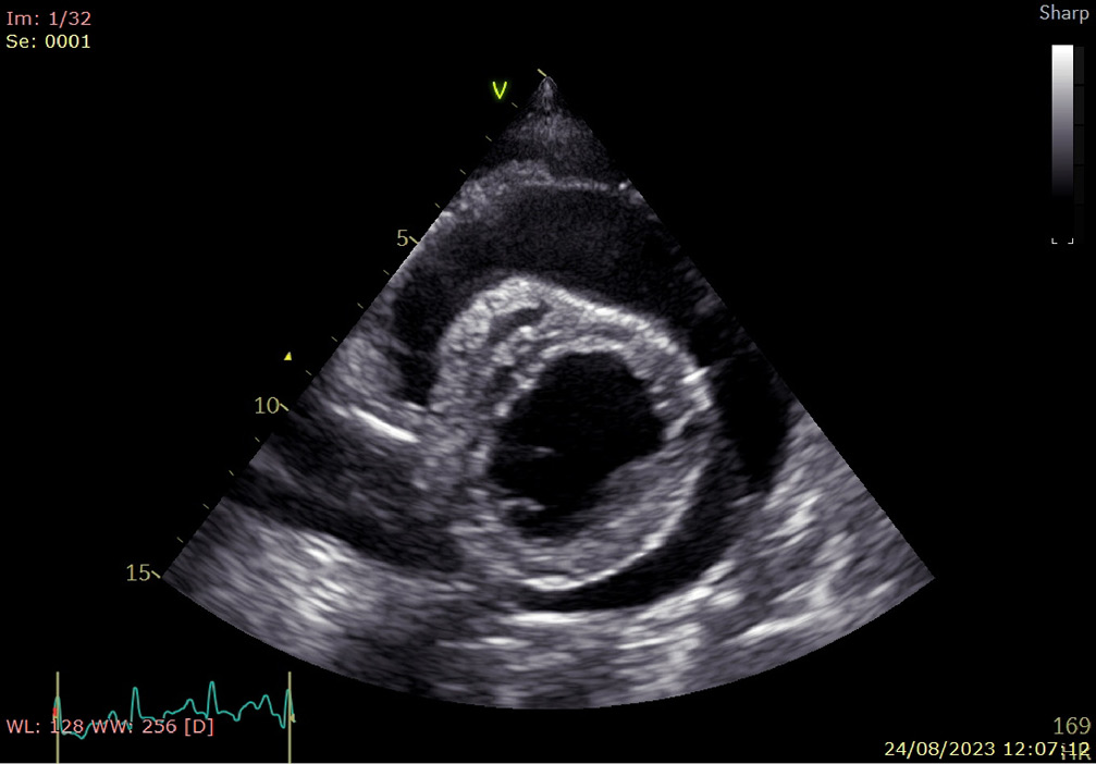Ecografía de un corazón en un ultrasonido médico