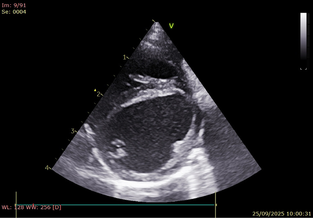 Ecocardiografía: dilatación ventrículo izquierdo.