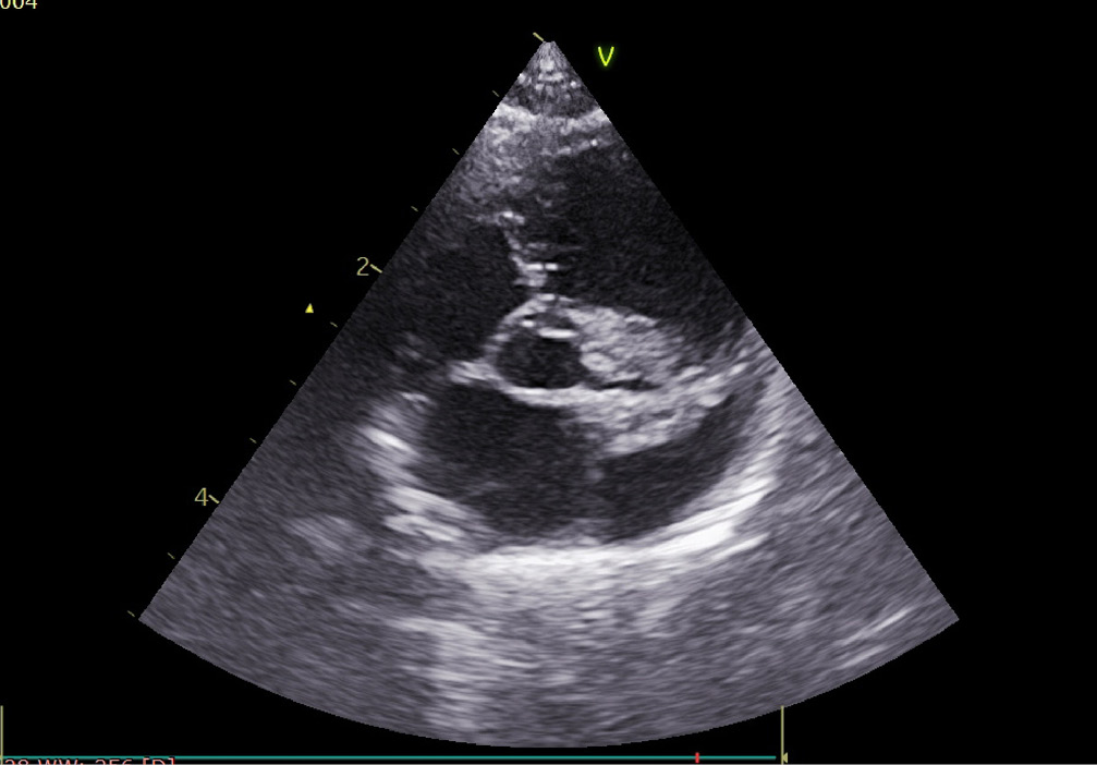 Ecocardiografía: ratio AI/Ao.