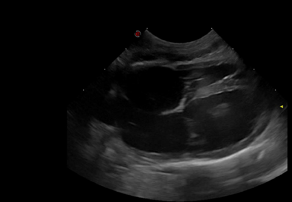 Ecocardiografía: dilatación de ventrículo izquierdo y ambos atrios.